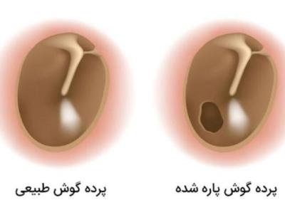 از علت تا درمان پارگی پرده گوش