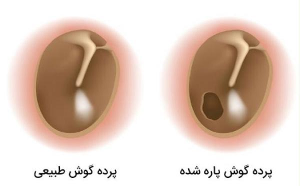از علت تا درمان پارگی پرده گوش